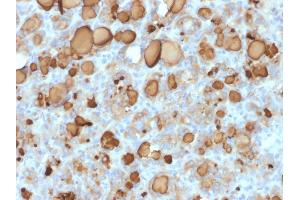 Formalin-fixed, paraffin-embedded human Thyroid Carcinoma stained with Thyroglobulin Mouse Recombinant Monoclonal Antibody (rTGB24). (Recombinant Thyroglobulin antibody)