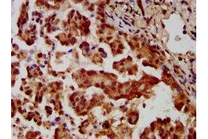 IHC image of ABIN7159000 diluted at 1:400 and staining in paraffin-embedded human lung cancer performed on a Leica BondTM system. (MBIP antibody  (AA 91-241))