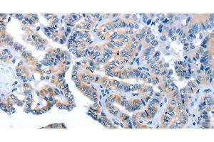 Immunohistochemistry of paraffin-embedded Human thyroid cancer using AMDHD2 Polyclonal Antibody at dilution of 1:40 (AMDHD2 antibody)