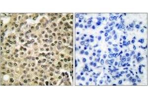 Immunohistochemistry analysis of paraffin-embedded human breast carcinoma tissue, using RAN Antibody. (RAN antibody  (AA 167-216))