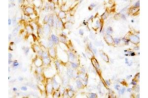 IHC-P: beta Defensin 1 antibody testing of lung cancer tissue
