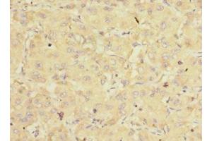 Immunohistochemistry of paraffin-embedded human liver cancer using ABIN7152170 at dilution of 1:100 (EIF3K antibody  (AA 1-218))