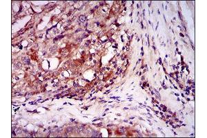 Immunohistochemical analysis of paraffin-embedded esophageal cancer tissues using ILK mouse mAb with DAB staining.