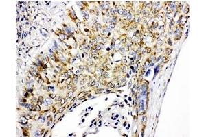 IHC-P: Prohibitin antibody testing of human lung cancer tissue (Prohibitin antibody  (C-Term))