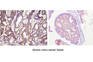 Paraffin embedded sections of human colon cancer tissue were incubated with anti-human ACOT11 (1:100) for 2 hours at room temperature. (ACOT11 antibody)