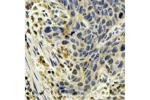 Immunohistochemical analysis of Cytochrome P450 1A1 staining in human esophageal cancer formalin fixed paraffin embedded tissue section. (CYP1A1 antibody)
