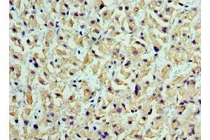 Immunohistochemistry of paraffin-embedded human liver cancer using ABIN7149003 at dilution of 1:100