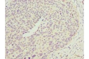 Immunohistochemistry of paraffin-embedded human cervical cancer using ABIN7147492 at dilution of 1:100