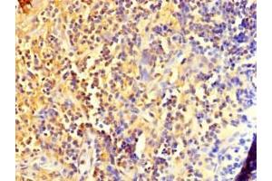 Immunohistochemistry of paraffin-embedded human bladder cancer using ABIN7150017 at dilution of 1:100 (DIS3L2 antibody  (AA 201-400))