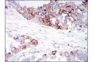 Immunohistochemical analysis of paraffin-embedded ovarian cancer tissues using CK5 mouse mAb with DAB staining.