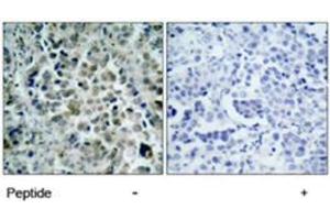 Immunohistochemical analysis of paraffin-embedded human breast carcinoma tissue using HDAC8 polyclonal antibody  . (HDAC8 antibody)