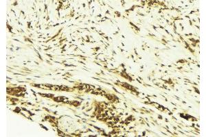 ABIN6269171 at 1/100 staining Human breast cancer tissue by IHC-P. (JunD antibody)