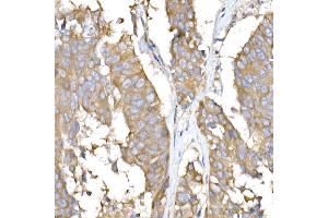 Immunohistochemistry of paraffin-embedded human lung cancer using USO1 Rabbit mAb (ABIN7271234) at dilution of 1:25 (40x lens). (USO1 antibody)