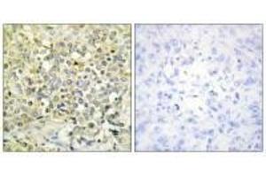 Immunohistochemistry analysis of paraffin-embedded human lung carcinoma tissue using CDKL4 antibody. (CDKL4 antibody  (C-Term))