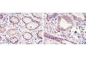 Immunohistochemical analysis of paraffin-embedded gastric cancer tissues (left) and lung cancer tissues (right) using CDH1 antibody with DAB staining. (E-cadherin antibody)