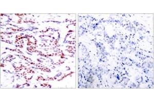 Immunohistochemistry analysis of paraffin-embedded human breast carcinoma, using ATF2 (Phospho-Thr71 or 53) Antibody.
