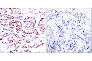 Immunohistochemistry analysis of paraffin-embedded human breast carcinoma, using ATF2 (Phospho-Thr71 or 53) Antibody. (ATF2 antibody  (pThr71))