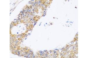 Immunohistochemistry of paraffin-embedded Human colon carcinoma using ZAK Polyclonal Antibody at dilution of 1:100 (40x lens). (ZAK antibody)