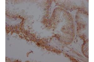 IHC image of ABIN7127366 diluted at 1:100 and staining in paraffin-embedded human prostate cancer performed on a Leica BondTM system. (Recombinant beta 2 Adrenergic Receptor antibody)