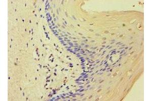 Immunohistochemistry of paraffin-embedded human cervical cancer using ABIN7159821 at dilution of 1:100 (MCMBP antibody  (AA 1-240))
