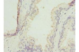 Immunohistochemistry of paraffin-embedded human prostate cancer using ABIN7176258 at dilution of 1:100 (ZNF35 antibody  (AA 233-532))