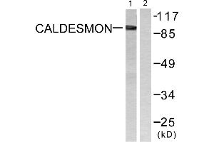 Immunohistochemistry analysis of paraffin-embedded human breast carcinoma tissue using Caldesmon (Ab-789) antibody.