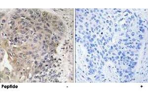 Immunohistochemistry analysis of paraffin-embedded human lung carcinoma tissue using AGBL3 polyclonal antibody . (AGBL3 antibody)