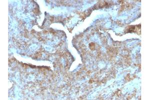 Formalin-fixed, paraffin-embedded human Prostate Carcinoma stained with Thymidine Phosphorylase Rabbit Recombinant Monoclonal (TYMP/2890R). (Recombinant Thymidine Phosphorylase antibody)