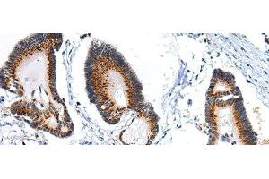 Immunohistochemistry of paraffin-embedded Human colorectal cancer using ARFGAP2 Polyclonal Antibody at dilution of 1/25