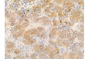ABIN6263207 and ABIN6277295 at 1/100 staining human thymoma by IHC-P. (MEF2C antibody  (C-Term))