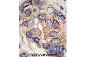Formalin-fixed and paraffin-embedded human hepatocellular carcinoma reacted with PDGFRA polyclonal antibody  , which was peroxidase-conjugated to the secondary antibody, followed by DAB staining. (PDGFRA antibody  (Tyr720))