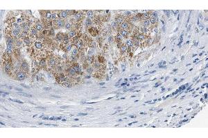 ABIN6274572 at 1/100 staining Human liver cancer tissue by IHC-P. (Serotonin Receptor 2B antibody  (Internal Region))
