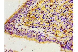 Immunohistochemistry of paraffin-embedded human lung cancer using ABIN7146450 at dilution of 1:100 (CACYBP antibody  (AA 2-228))