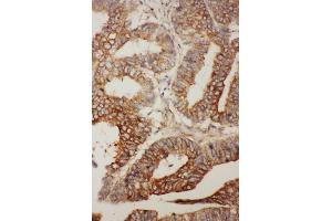 Anti- BCL2L2 antibody, IHC(P) IHC(P): Human Rectal Cancer Tissue (BCL2L2 antibody  (Middle Region))