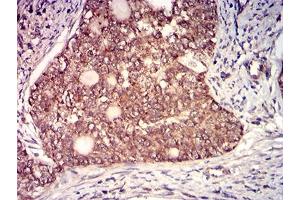 Immunohistochemical analysis of paraffin-embedded cervical cancer tissues using CD130 mouse mAb with DAB staining. (CD130/gp130 antibody  (AA 73-231))