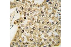 IHC analysis of FFPE human breast carcinoma tissue stained with the MDM2 antibody (MDM2 antibody  (AA 141-176))