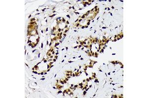 Immunohistochemistry of paraffin-embedded human breast cancer using ILF2 Rabbit mAb (ABIN7268007) at dilution of 1:100 (40x lens). (ILF2 antibody)