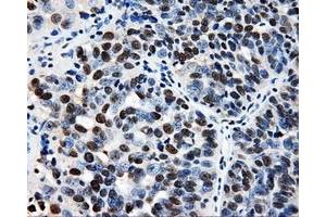 Immunohistochemical staining of paraffin-embedded Adenocarcinoma of breast tissue using anti-RALBP1 mouse monoclonal antibody.