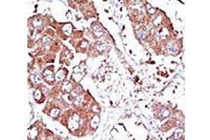 IHC analysis of FFPE human hepatocarcinoma tissue stained with the ALK3 antibody (BMPR1A antibody  (AA 166-195))