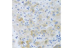 Immunohistochemistry of paraffin-embedded human liver using SLC4 antibody (ABIN6132890, ABIN6148015, ABIN6148016 and ABIN6214688) at dilution of 1:100 (40x lens).