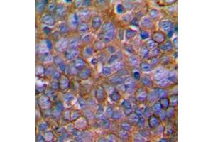 Immunohistochemical analysis of MKK1 staining in human prostate cancer formalin fixed paraffin embedded tissue section. (MEK1 antibody  (Center))