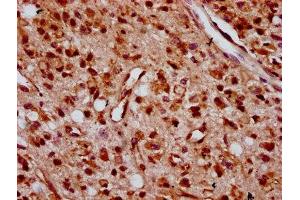 IHC image of ABIN7176263 diluted at 1:400 and staining in paraffin-embedded human glioma performed on a Leica BondTM system. (ZNF367 antibody  (AA 83-151))