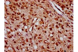 IHC image of ABIN7176263 diluted at 1:400 and staining in paraffin-embedded human glioma performed on a Leica BondTM system.