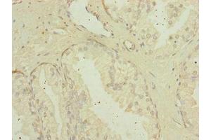 Immunohistochemistry of paraffin-embedded human prostate cancer using ABIN7159922 at dilution of 1:100 (MIPEP antibody  (AA 504-713))