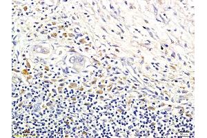 Formalin-fixed and paraffin embedded human colorectal cancer labeled with Anti-LI-cadherin Polyclonal Antibody, Unconjugated (ABIN732128) followed by conjugation to the secondary antibody and DAB staining (LI Cadherin antibody  (AA 101-200))