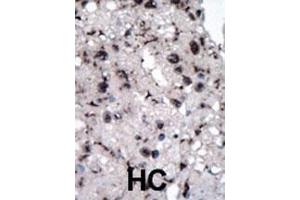 Formalin-fixed and paraffin-embedded human cancer tissue reacted with the primary antibody, which was peroxidase-conjugated to the secondary antibody, followed by DAB staining. (Hexokinase 2 antibody  (AA 401-431))