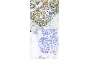 Immunohistochemical staining (Formalin-fixed paraffin-embedded sections) of human breast cancer tissue with TNK2 (phospho Y284) polyclonal antibody  without blocking peptide (A) or preincubated with blocking peptide (B) under 1:50-1:100 dilution. (TNK2 antibody  (pTyr284))