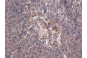 Detection of CSF2Rb in Human Ovarian cancer Tissue using Polyclonal Antibody to Colony Stimulating Factor 2 Receptor Beta (CSF2Rb) (CD131 antibody  (AA 133-233))