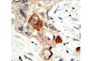 IHC analysis of FFPE human breast carcinoma tissue stained with the UBE2I antibody (UBE2I antibody  (AA 1-30))