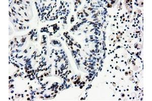 Immunohistochemical staining of paraffin-embedded Adenocarcinoma of Human breast tissue using anti-NT5DC1 mouse monoclonal antibody. (NT5DC1 antibody)